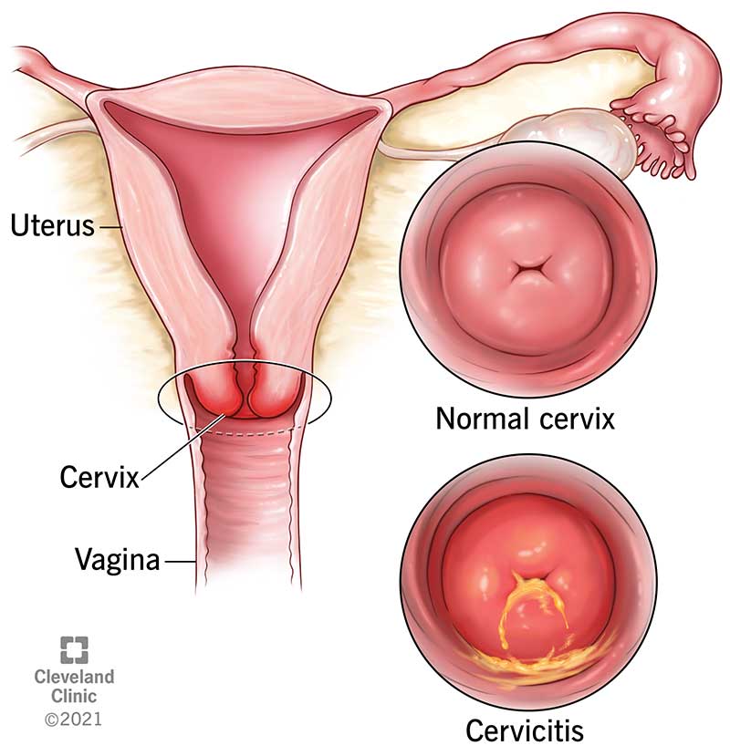 Acute Gonococcal Cervicitis