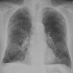 Acute exacerbation of obstructive chronic bronchitis by Streptococcus