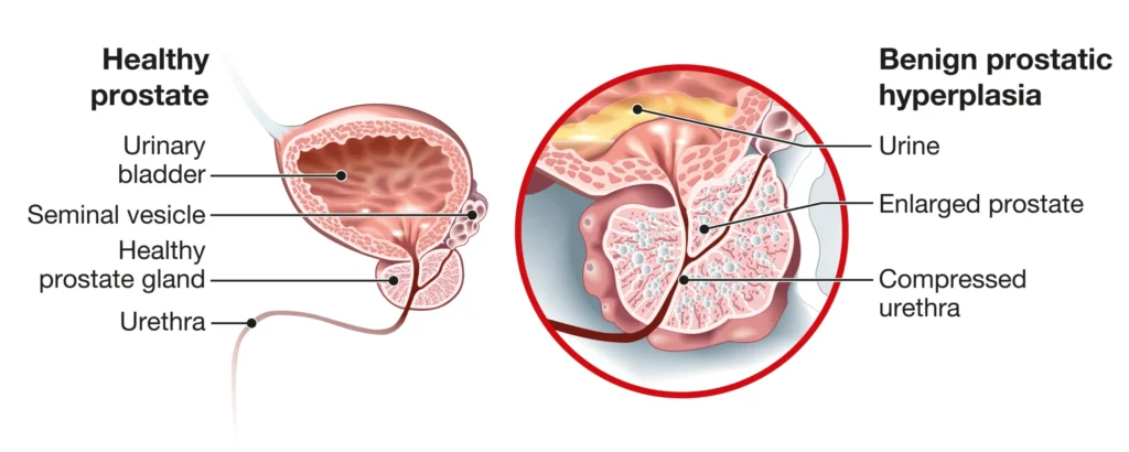 benign prostatic hyperplasia