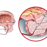 benign prostatic hyperplasia