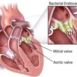 bacterial endocarditis