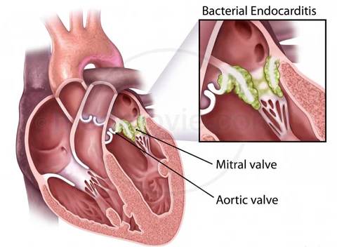 bacterial endocarditis