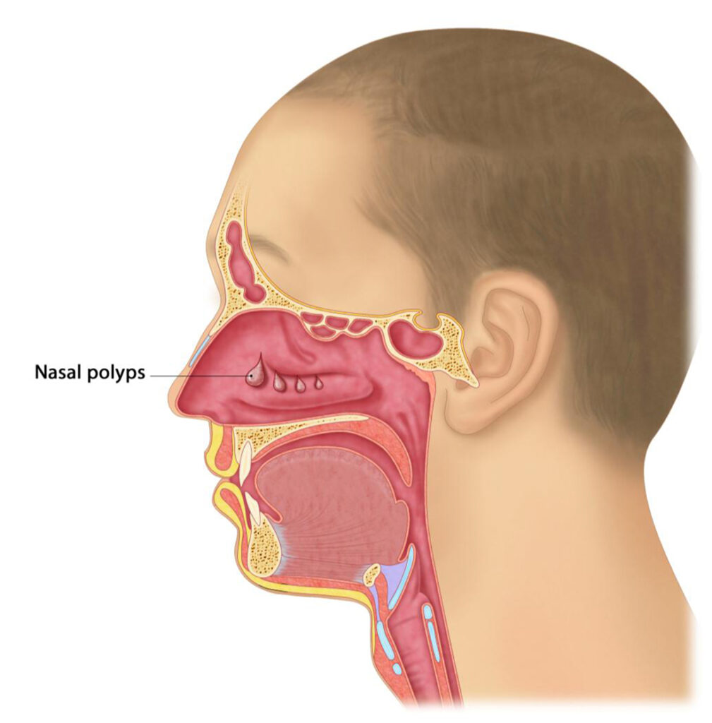 Chronic rhinosinusitis with nasal polyposis