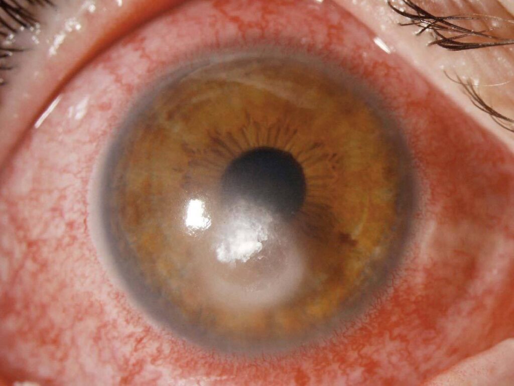 bacterial corneal ulcer infection