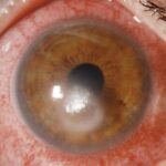 bacterial corneal ulcer infection