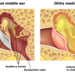 Otitis-Media