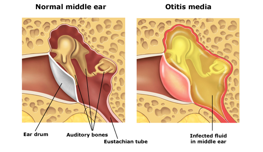 Otitis-Media