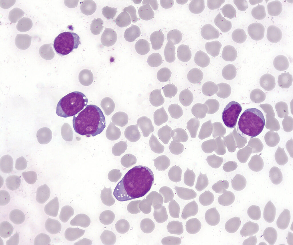 b-cell acute lymphoblastic leukemia