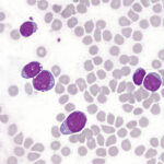 b-cell acute lymphoblastic leukemia