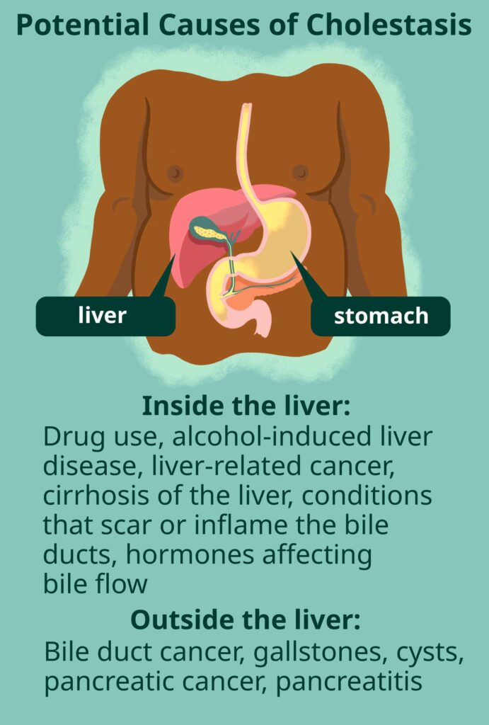 biliary obstruction with pruritus