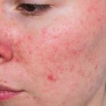 acne rosacea