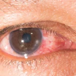 acne rosacea keratitis