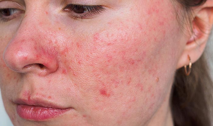 acne rosacea