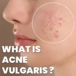 acne vulgaris