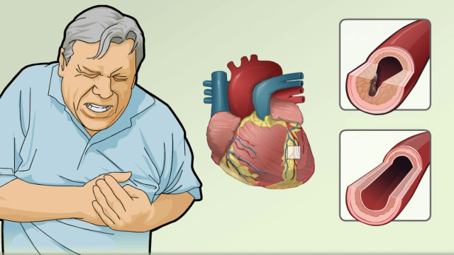 acute anginal pain