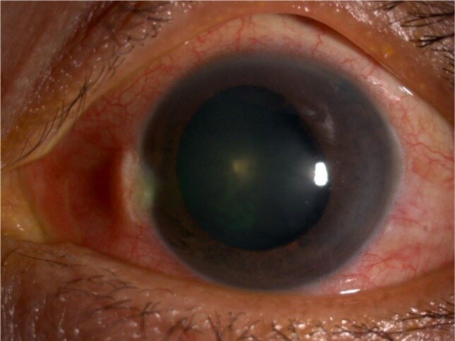 acute angle-closure glaucoma