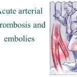 acute arterial thromboembolism