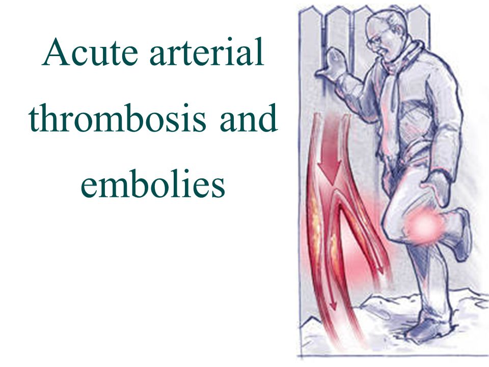 acute arterial thromboembolism