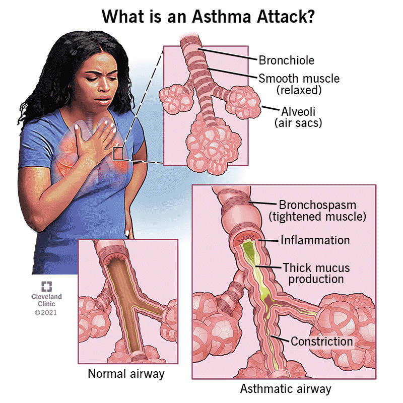 acute asthma attack