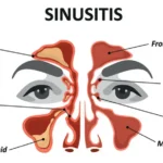 Acute Bacterial Maxillary Sinusitis