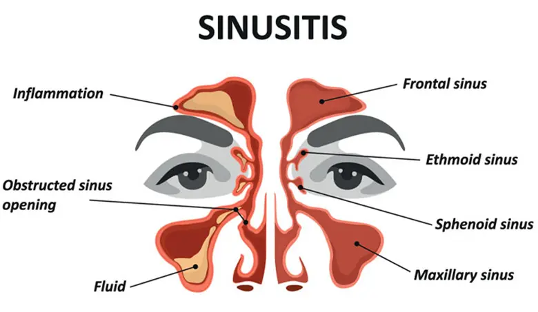 Acute Bacterial Maxillary Sinusitis