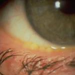 bacterial blepharitis