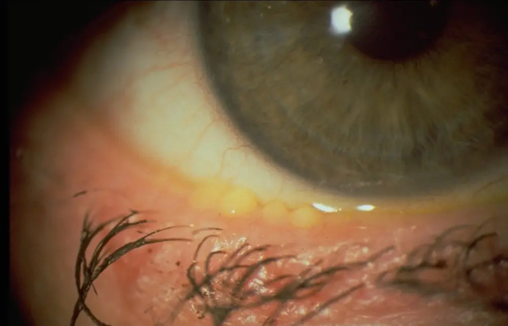 bacterial blepharitis