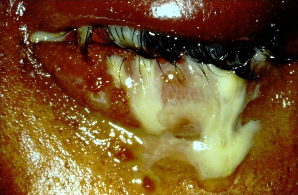 bacterial conjunctivitis