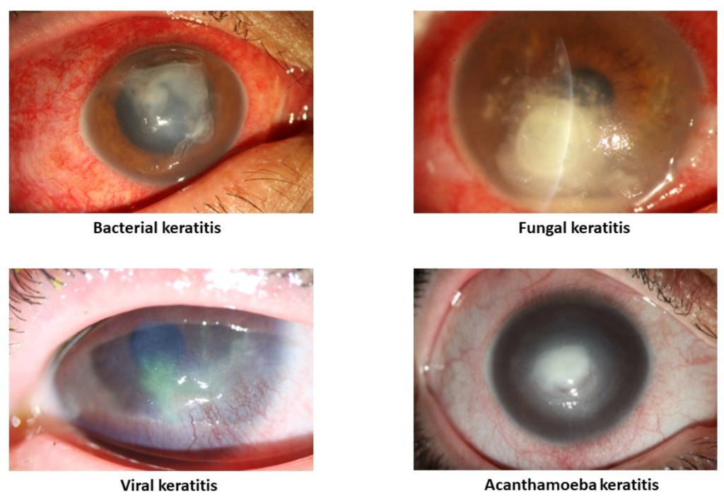 bacterial corneal ulcer infection