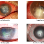 bacterial corneal ulcer infection