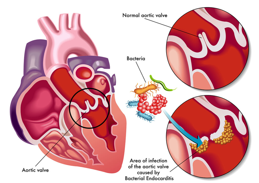 bacterial endocarditis