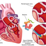 bacterial endocarditis