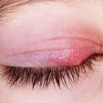 bacterial eye infection