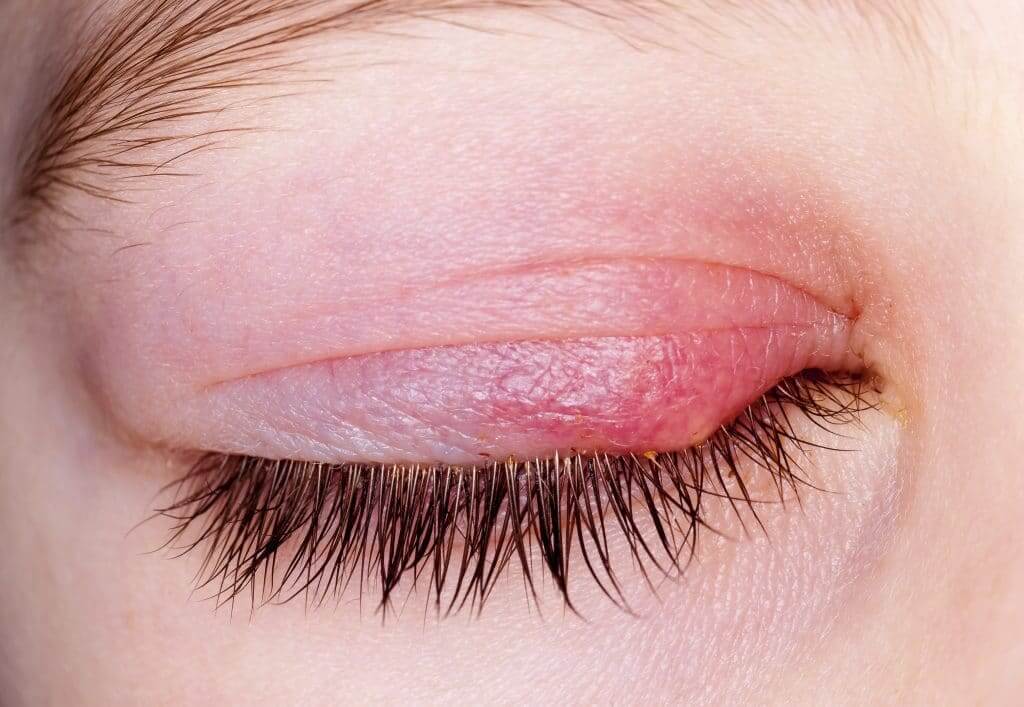 bacterial eye infection