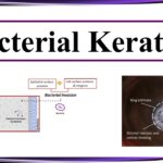 bacterial keratitis