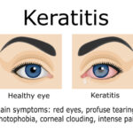 bacterial keratoconjunctivitis