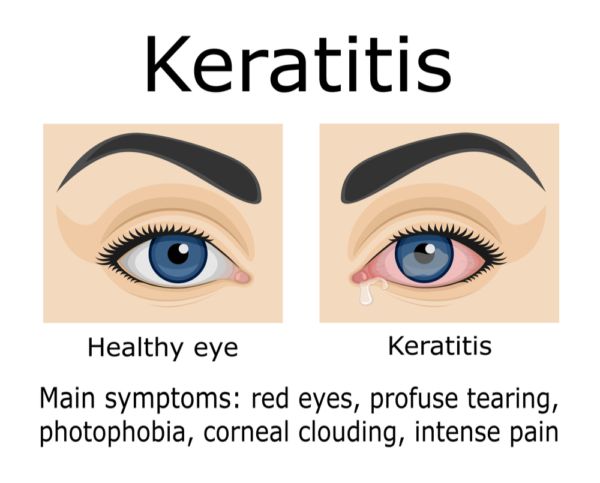 bacterial keratoconjunctivitis