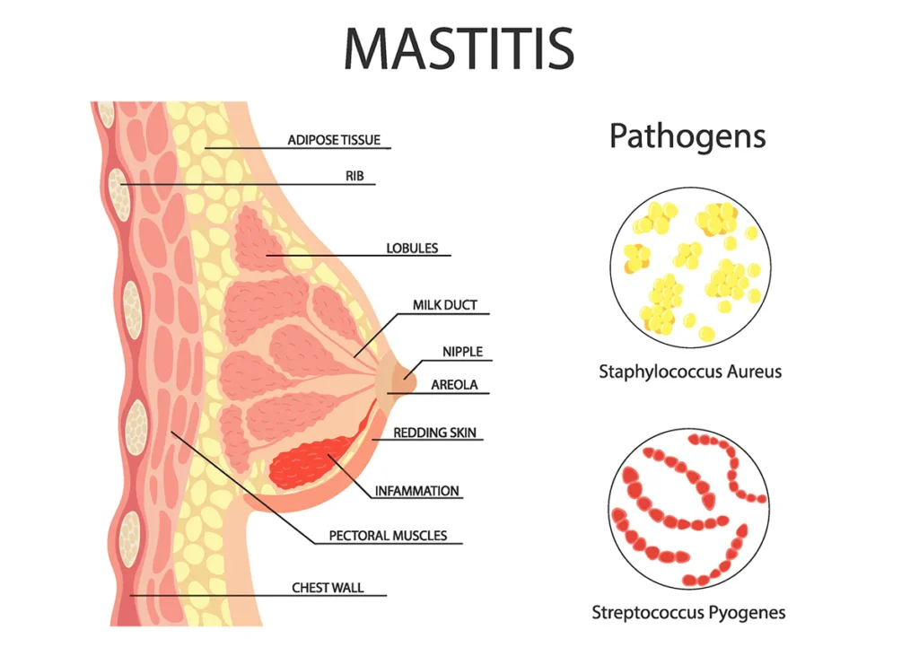 bacterial mastitis