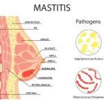 bacterial mastitis