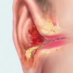 bacterial otitis externa