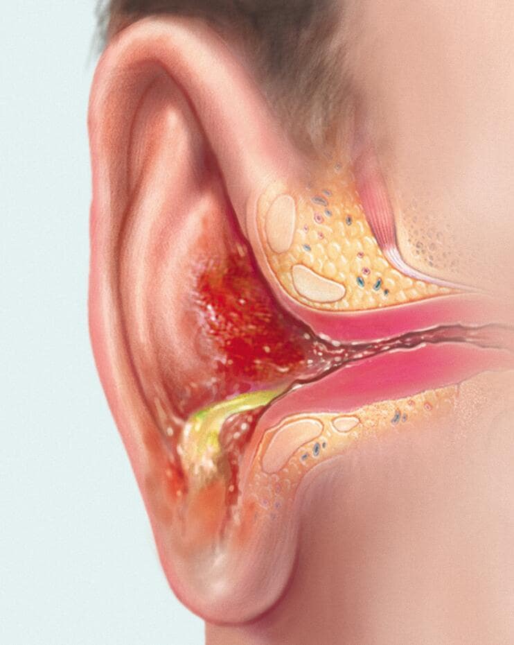 bacterial otitis externa