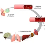 bacterial sepsis