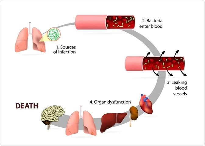 bacterial sepsis