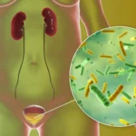 bacterial urinary tract infection