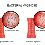 bacterial vaginosis