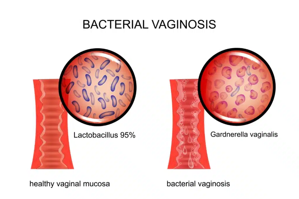 bacterial vaginosis