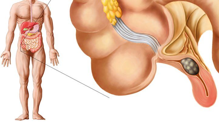 bacteroides appendicitis