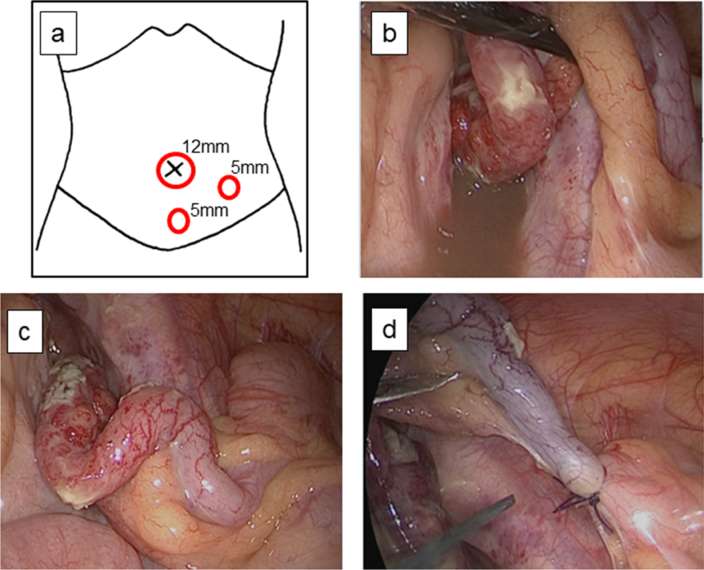 bacteroides complicated appendicitis