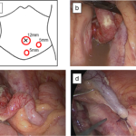 bacteroides complicated appendicitis