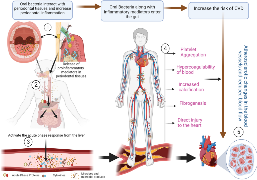 bacteroides endocarditis